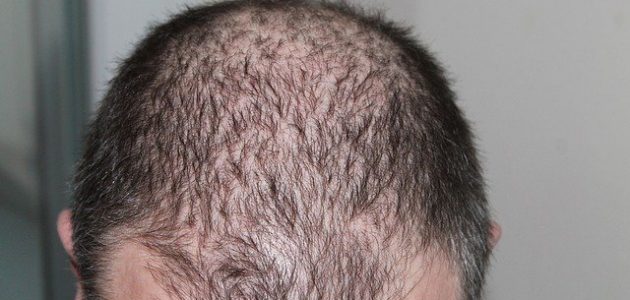 هل البشرة الدهنية تسبب تساقط الشعر