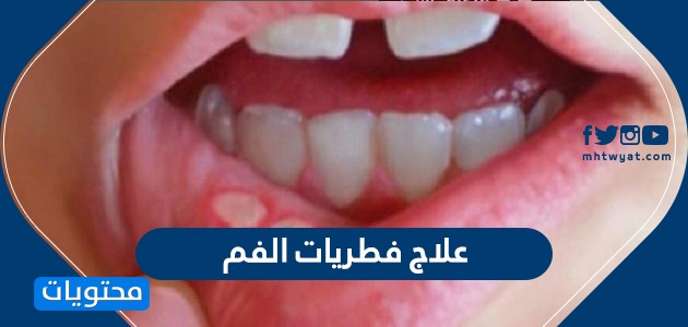 علاج فطريات الفم الطبية والمنزلية وأسباب الإصابة بها وأعراضها موقع محتويات