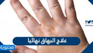 علاج البهاق نهائيا … علاج البهاق بالاعشاب واعراضه واسبابه