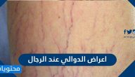 اعراض الدوالي عند الرجال وما هي أهم طرق علاجه