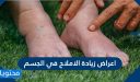 اعراض زيادة الاملاح في الجسم .. واسباب ومضاعفات وطرق علاج ارتفاع الأملاح