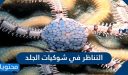 التناظر في شوكيات الجلد