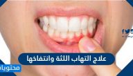 علاج التهاب اللثة وانتفاخها .. اسباب انتفاخ اللثة واعراضها وطريقة تشخيصها