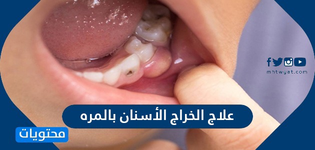 علاج الخراج الأسنان بالمره واهم طرق الوقاية منه