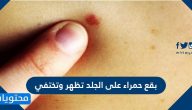 بقع حمراء على الجلد تظهر وتختفي الاسباب وطرق العلاج بالتفصيل