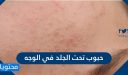 حبوب تحت الجلد في الوجه الأسباب وطرق العلاج