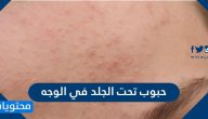 حبوب تحت الجلد في الوجه الأسباب وطرق العلاج