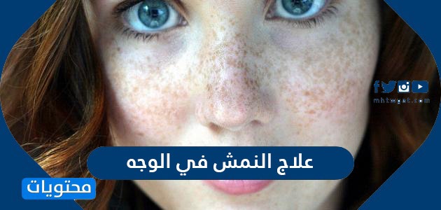 علاج النمش في الوجه