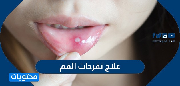 علاج تقرحات الفم بالطرق المنزلية والدوائية