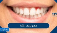 علاج نزيف اللثة المستمر والدائم بالطرق الطبيعية والطبية بالتفصيل