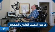 ما هو التصلب الجانبي الضموري .. اسبابه واعراضه وطرق تشخيصه وعلاجه
