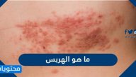 ما هو الهربس واعراضه واسبابه وطرق علاجه والوقاية منه
