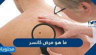 ما هو الكانسر وما انواعه واعراضه واسبابه وطرق تشخيصه وعلاجه
