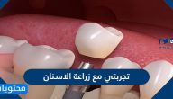 تجربتي مع زراعة الاسنان في السعودية بدون ألم أو شق جراحي