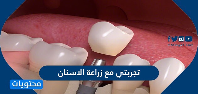 تجربتي مع زراعة الاسنان في السعودية بدون ألم أو شق جراحي