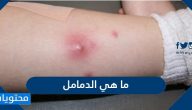 ما هي الدمامل وسبب ظهورها وكيفية علاجها وطرق الوقاية من حدوثها