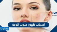 ما هي اسباب ظهور حبوب الوجه وما طرق علاجها وانواعها