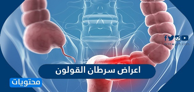 ما هي اعراض سرطان القولون وما اسبابه وطرق علاجه والوقاية من حدوثه