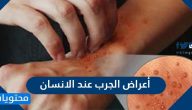 ما هي اعراض الجرب عند الانسان وما اسبابه وطرق تشخيصه وعلاجه