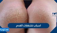 اسباب تشققات القدم وكيفية علاج تشققات القدم بالطرق الطبيعية