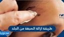 طريقة إزالة الصبغة من الجلد بالخل الأبيض أو بيكربونات الصوديوم