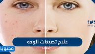 علاج تصبغات الوجه وأهم أسباب تصبغات الوجه