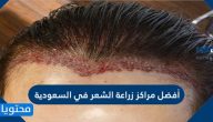 أفضل مراكز زراعة الشعر في السعودية