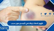 ظهور كدمات زرقاء في الجسم بدون سبب