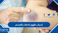 اسباب ظهور كدمات بالجسم