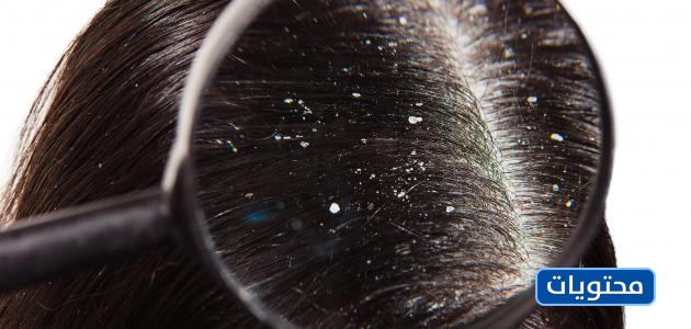 وصفات علاج قشرة الشعر