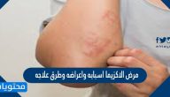 مرض الاكزيما اسبابه واعراضه وطرق علاجه
