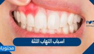 اسباب التهاب اللثة