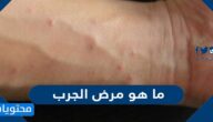 ما هو مرض الجرب