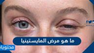 ما هو مرض المايستينيا