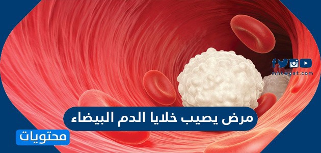 اللوكيميا مرض يصيب خلايا الدم الحمراء صح أو خطأ
