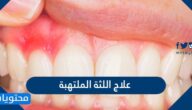 علاج اللثة الملتهبة