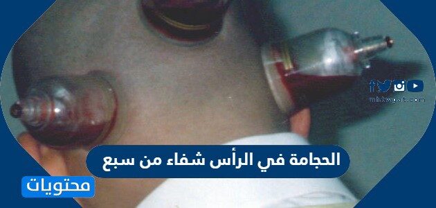 الحجامة في الرأس شفاء من سبع