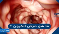 ما هو مرض كرون ؟ وما هي طرق علاجه؟
