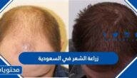 اسعار زراعة الشعر في السعودية واهم العيادات والأطباء