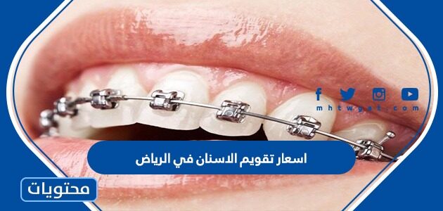اسعار تقويم الاسنان في الرياض