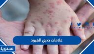 ما هي علامات جدري القرود