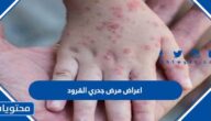 اعراض مرض جدري القرود