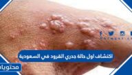 اكتشاف اول حالة جدري القرود في السعودية