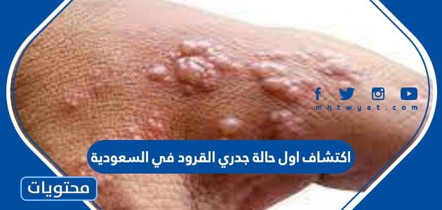 اكتشاف اول حالة جدري القرود في السعودية
