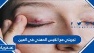 تجربتي مع الكيس الدهني في العين