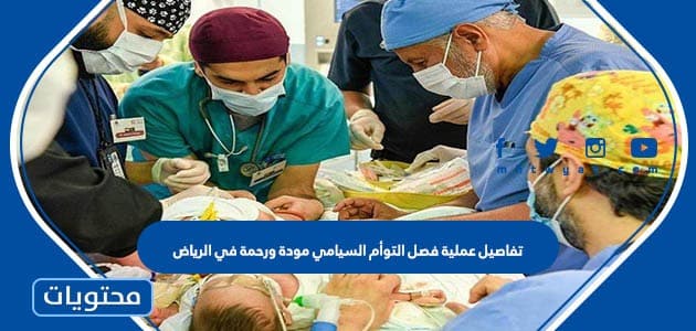 تفاصيل عملية فصل التوأم السيامي مودة ورحمة في الرياض