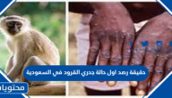 حقيقة رصد اول حالة جدري القرود في السعودية