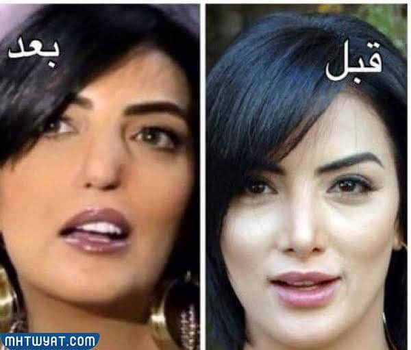 حورية فرغلي قبل وبعد عمليات التجميل