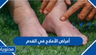 ما هي أعراض الأملاح في القدم