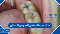 ما السبب المحتمل لتسوس الأسنان